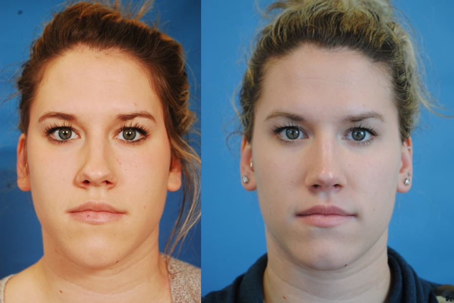 Before And After Rhinoplasty Photos