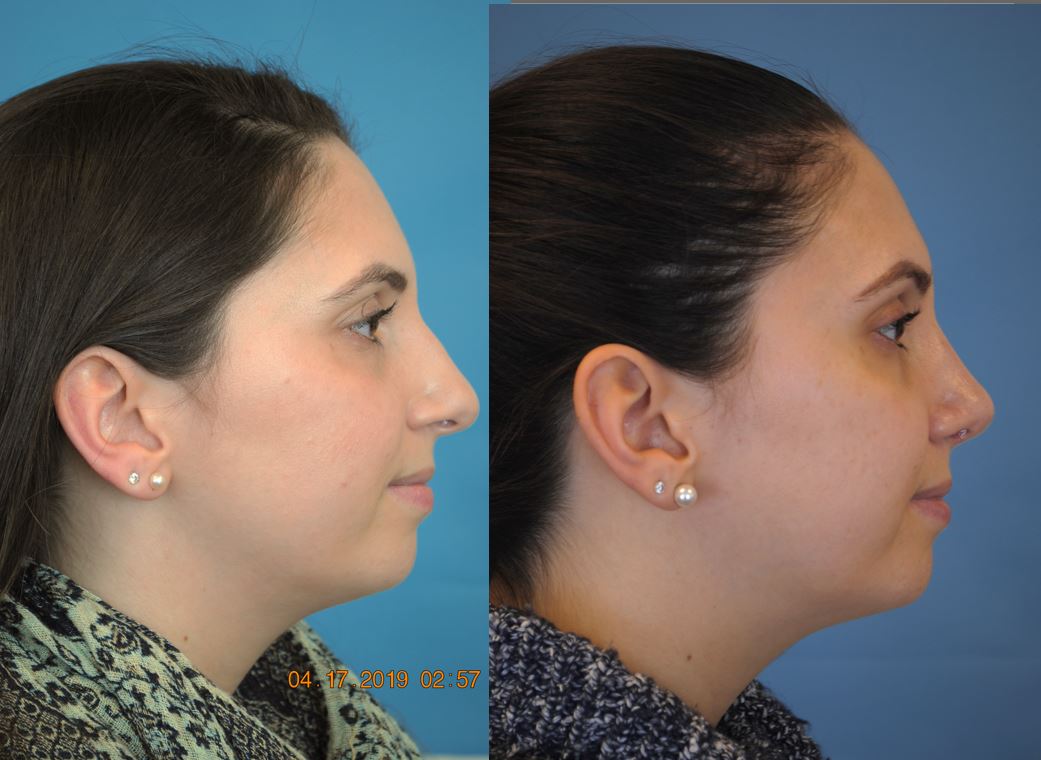 Before And After Rhinoplasty