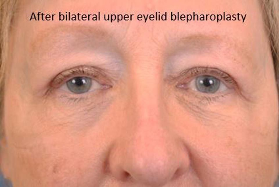 Blehpharoplasty