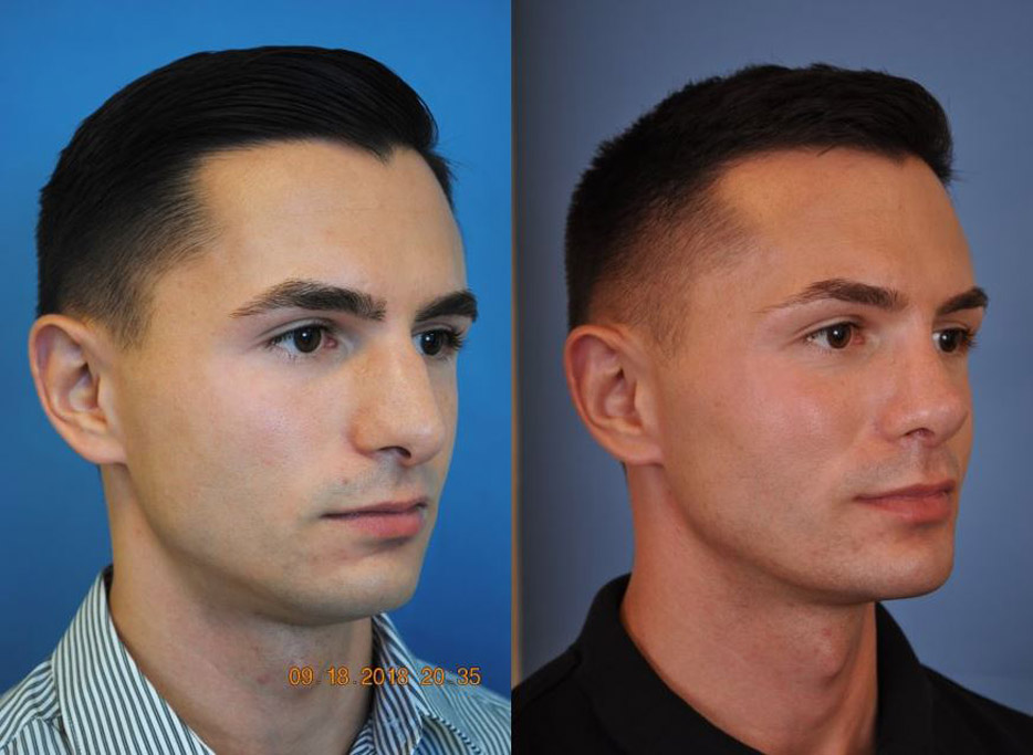 Rhinoplasty