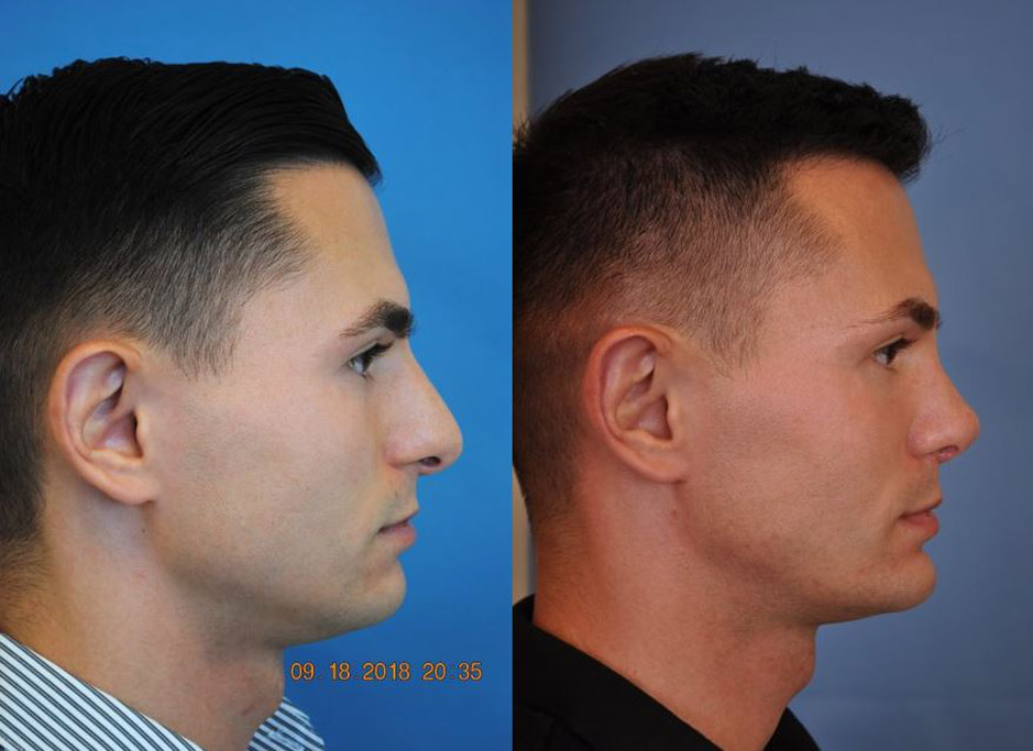 Rhinoplasty