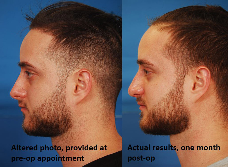 Rhinoplasty