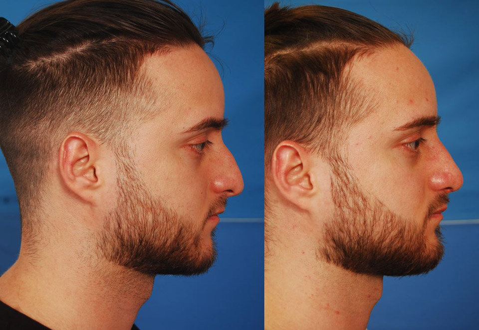 Rhinoplasty