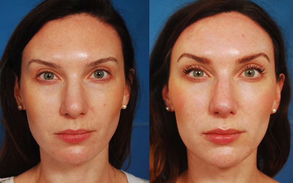 Botox, filler by Dr. Michael Reilly