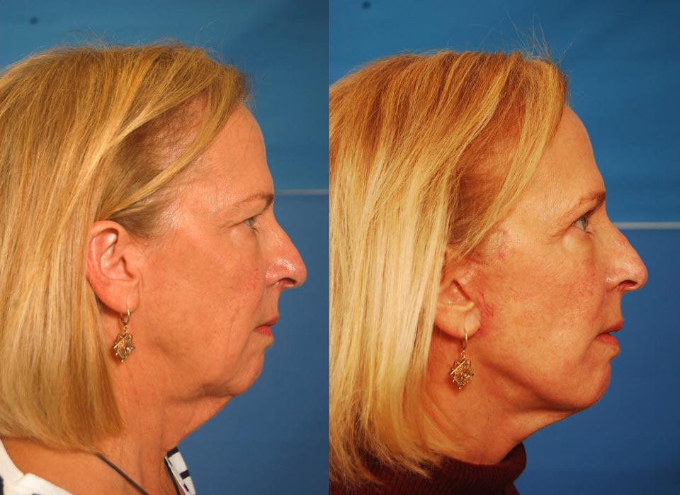 Facelift and necklift