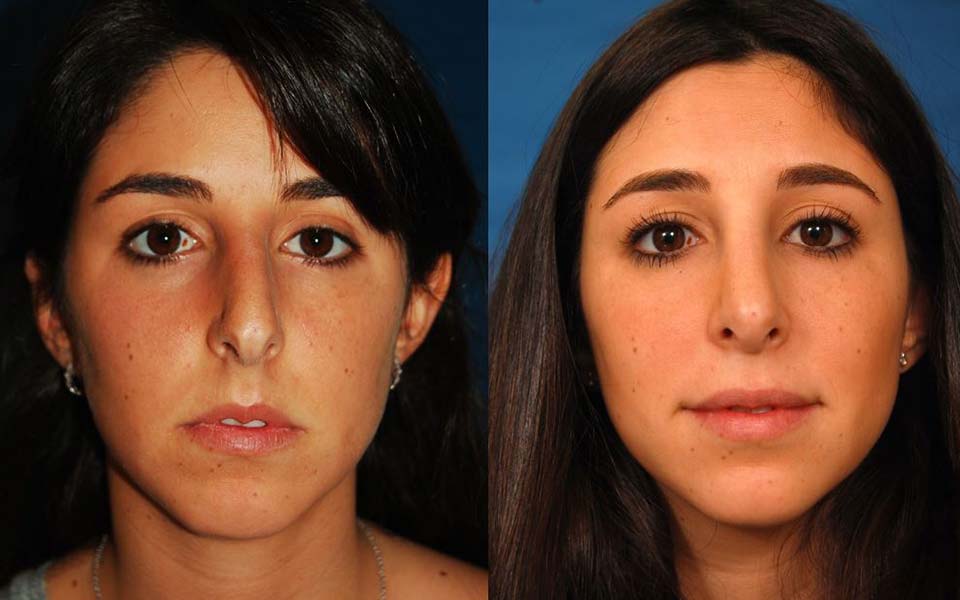 How Much is a Nose Job: Guide to Rhinoplasty Costs and Options