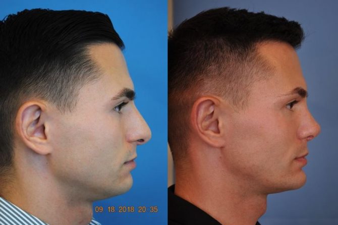 Communication is key for the best rhinoplasty results