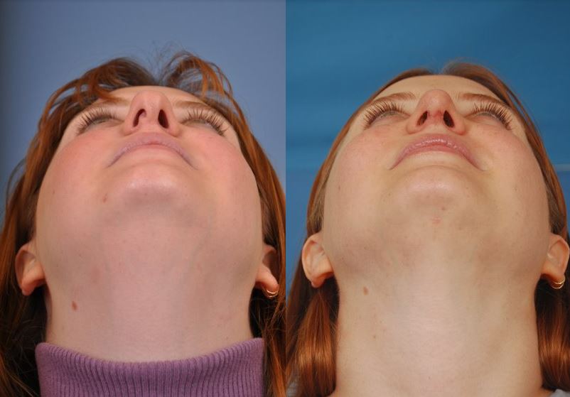 Rhinoplasty