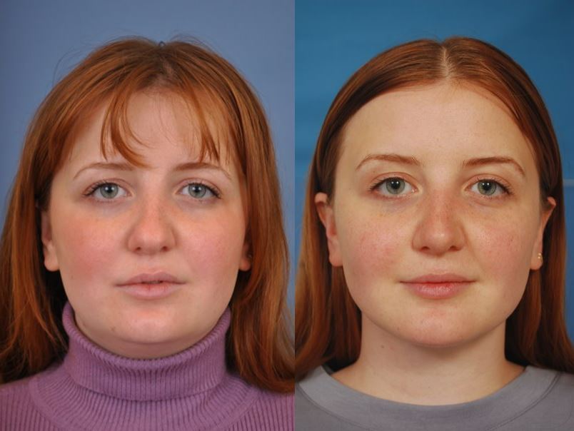 Rhinoplasty