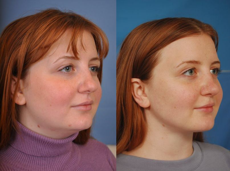 Rhinoplasty