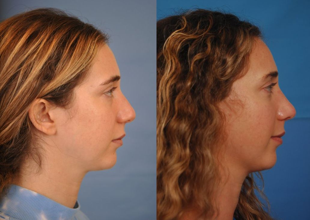 cosmetic and functional rhinoplasty