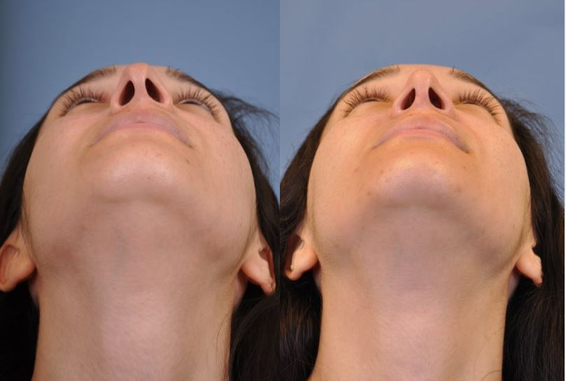 Rhinoplasty Before and After