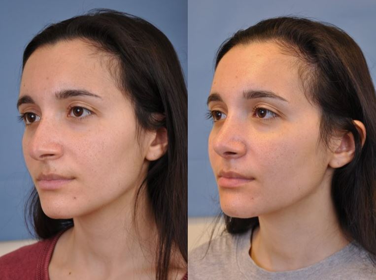 rhinoplasty