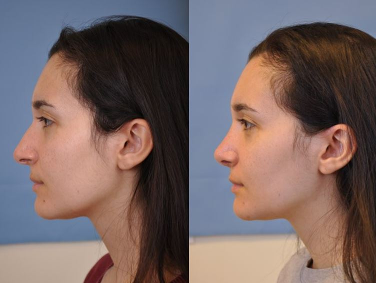 cosmetic rhinoplasty