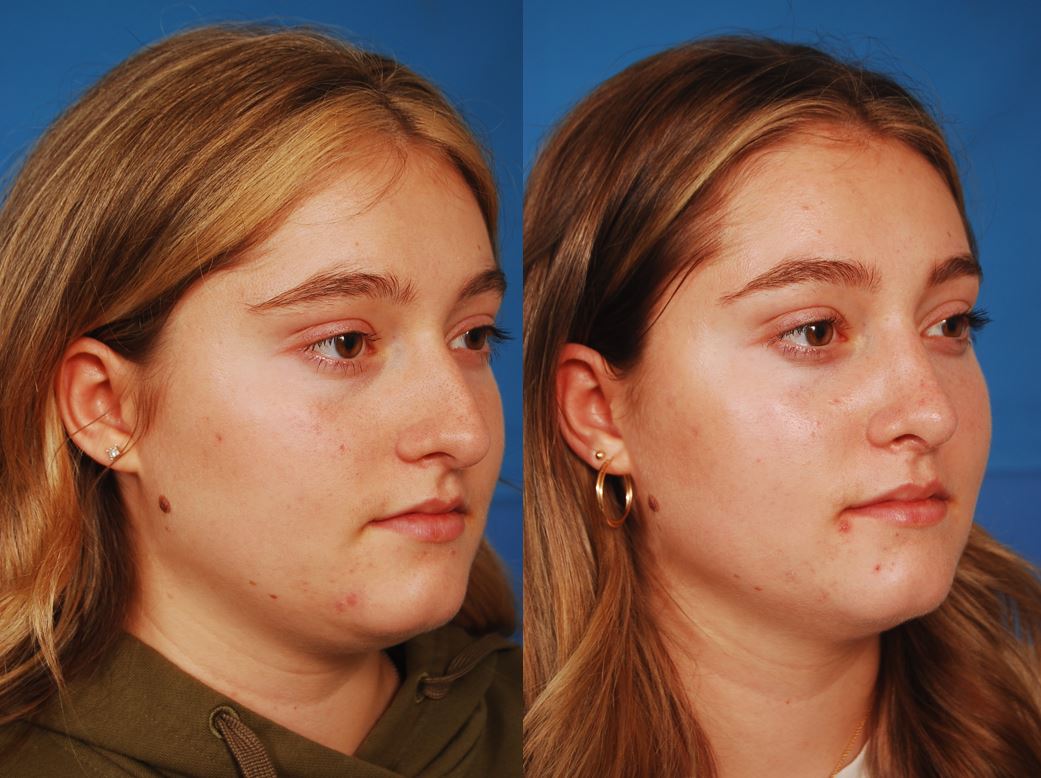 arigo right lateral rhinoplasty