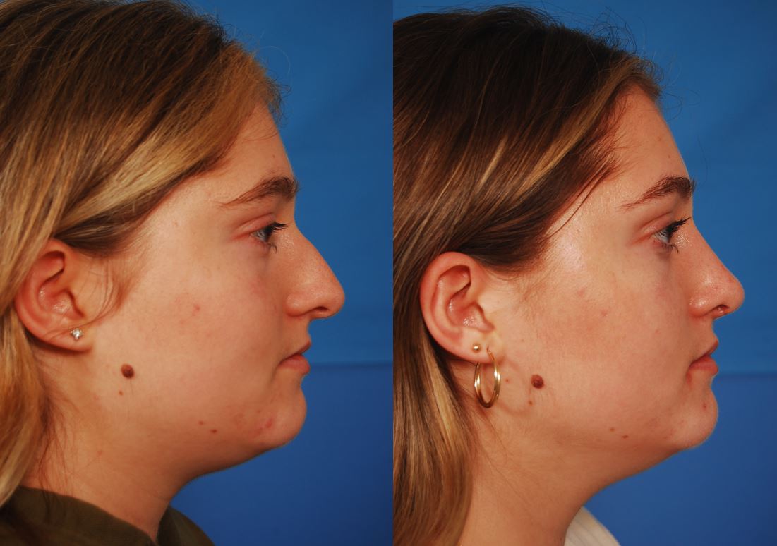 Tarigo right rhinoplasty