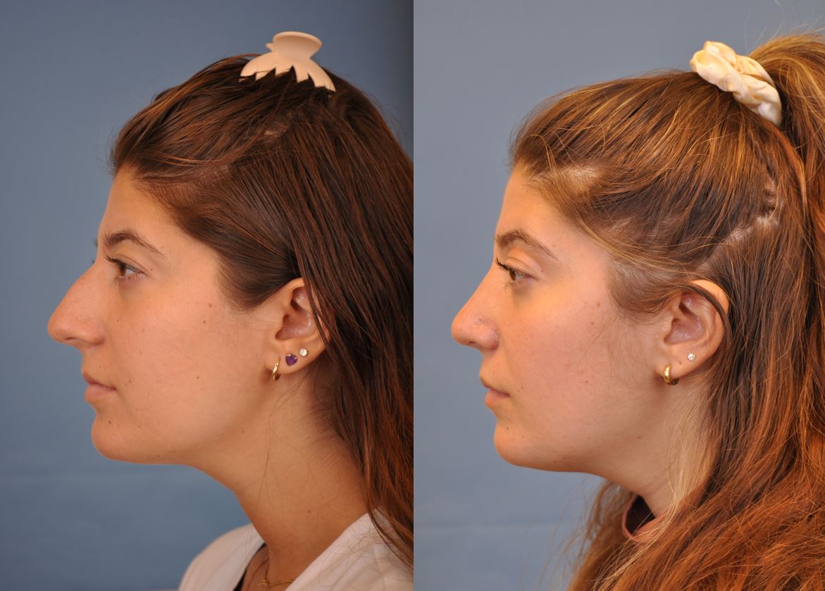 cosmetic rhinoplasty