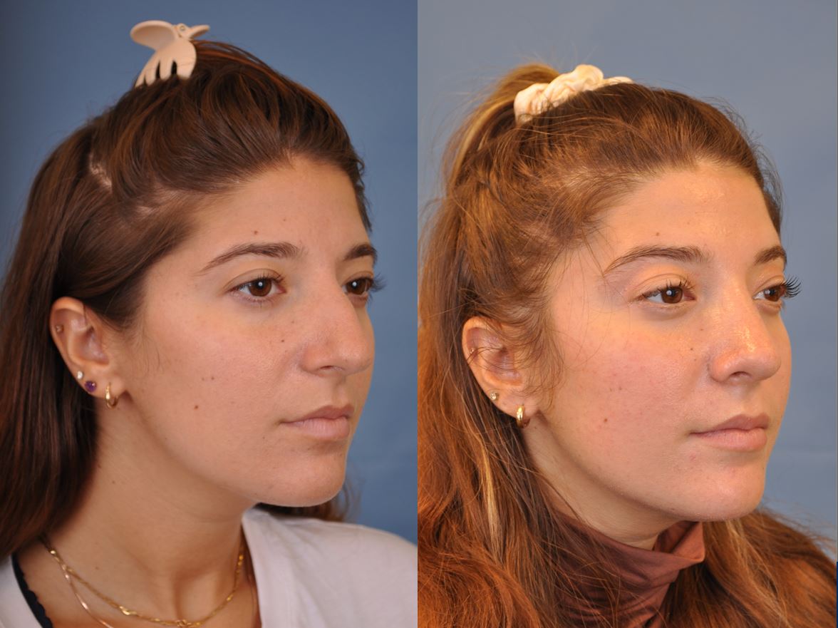 rhinoplasty before and after