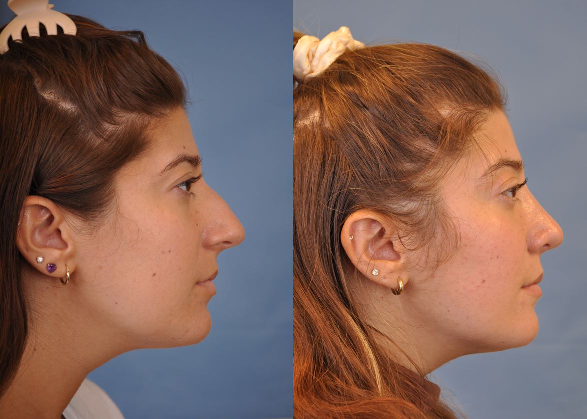 rhinoplasty befrore and after