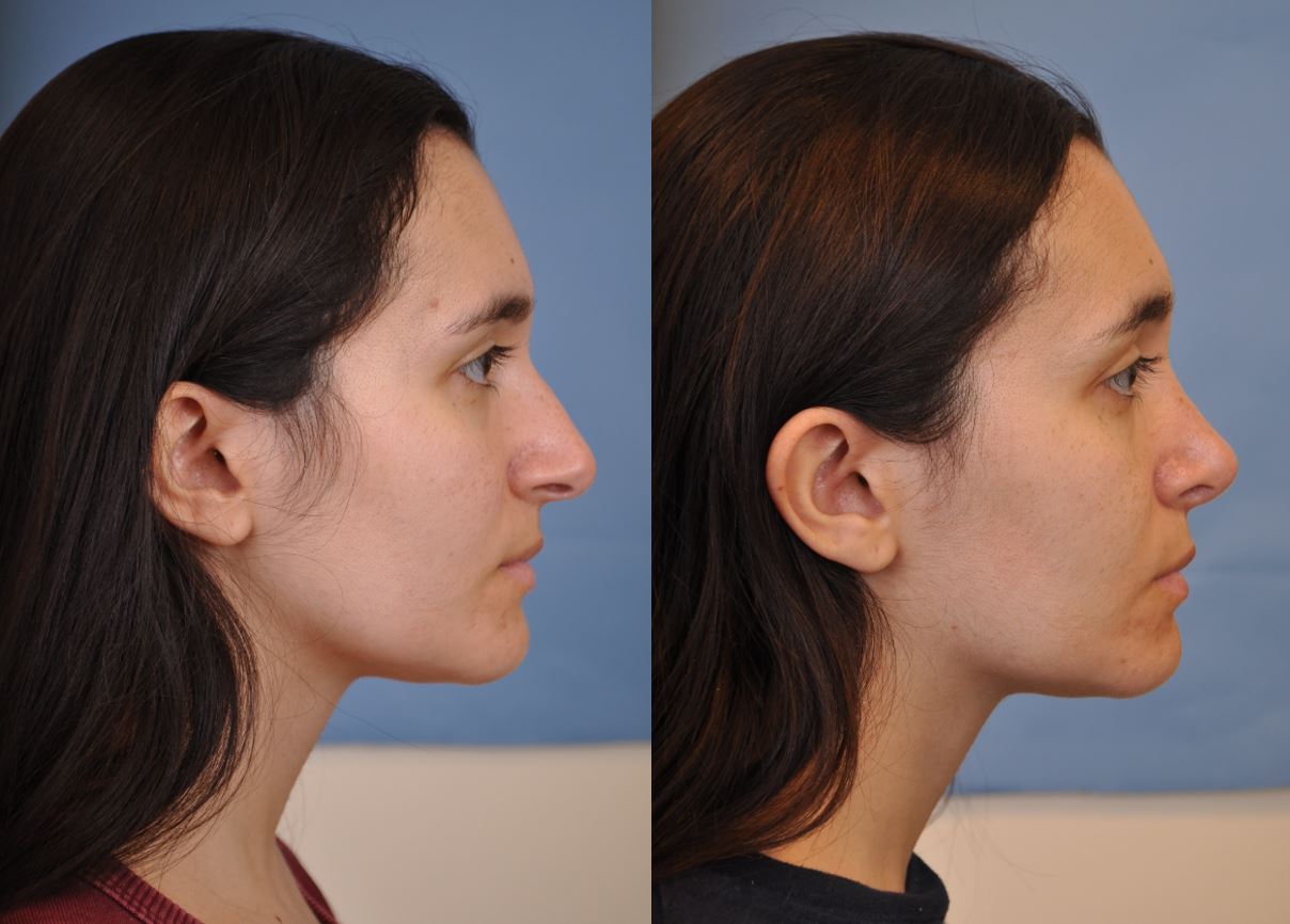 septoplasty and rhinoplasty before and after