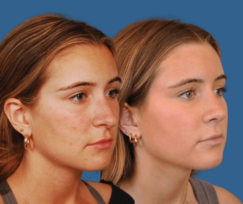 Rhinoplasty Before & After Alison