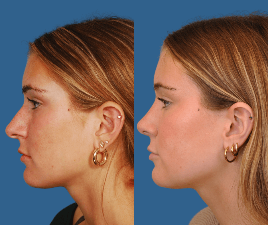 Rhinoplasty Before & After Alison