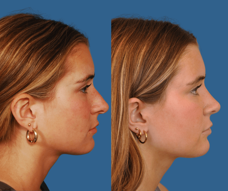 Rhinoplasty Before & After Alison