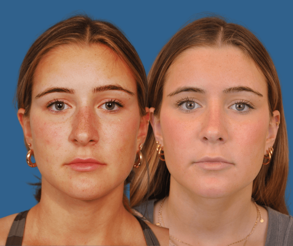 Rhinoplasty Before & After Alison