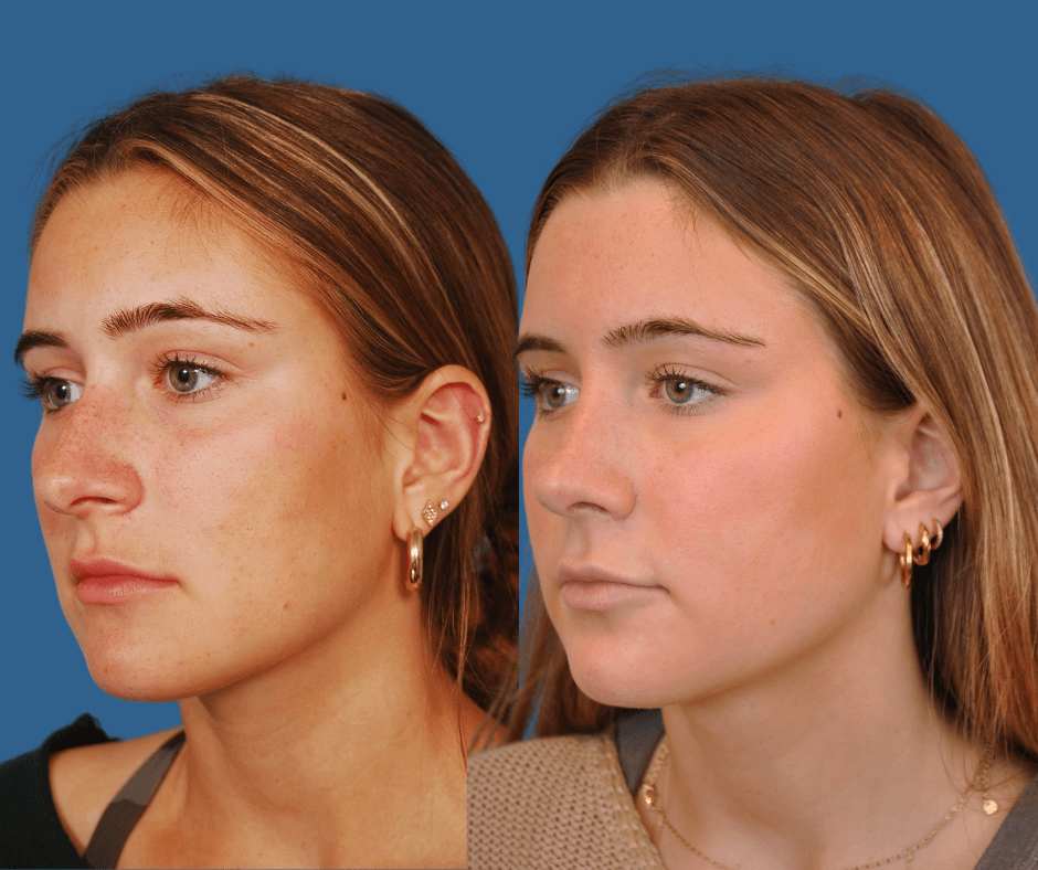 Rhinoplasty Before & After Alison