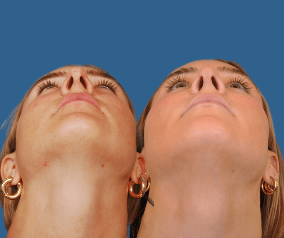 Rhinoplasty Before & After Alison
