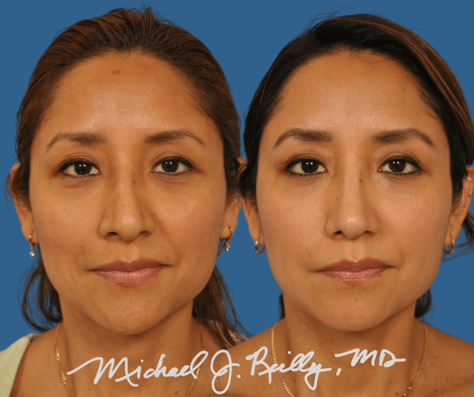 Rhinoplasty Surgeon DC