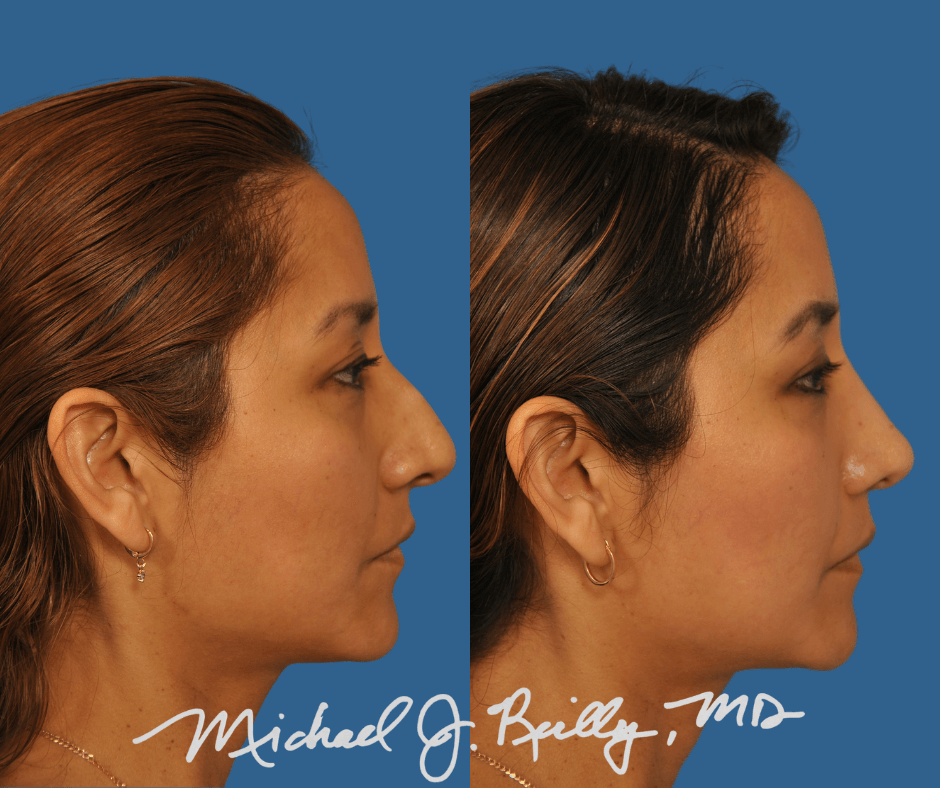 Rhinoplasty Washington DC